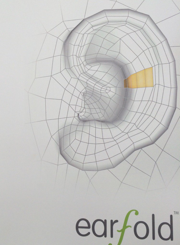 NugentNora's tweet photo. Looking forward to offering @earfold to my #prominentear patients @PurityBridgeTW #minimallyinvasive https://t.co/RRoDcjMTSG