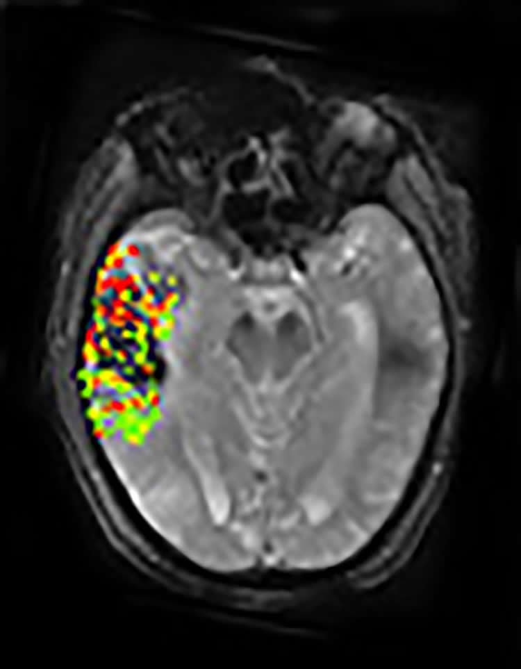 Predicting The Risk of Post Treatment Brain Bleeding Following a Stroke neurosciencenews.com/brain-bleeding… #neuroscience