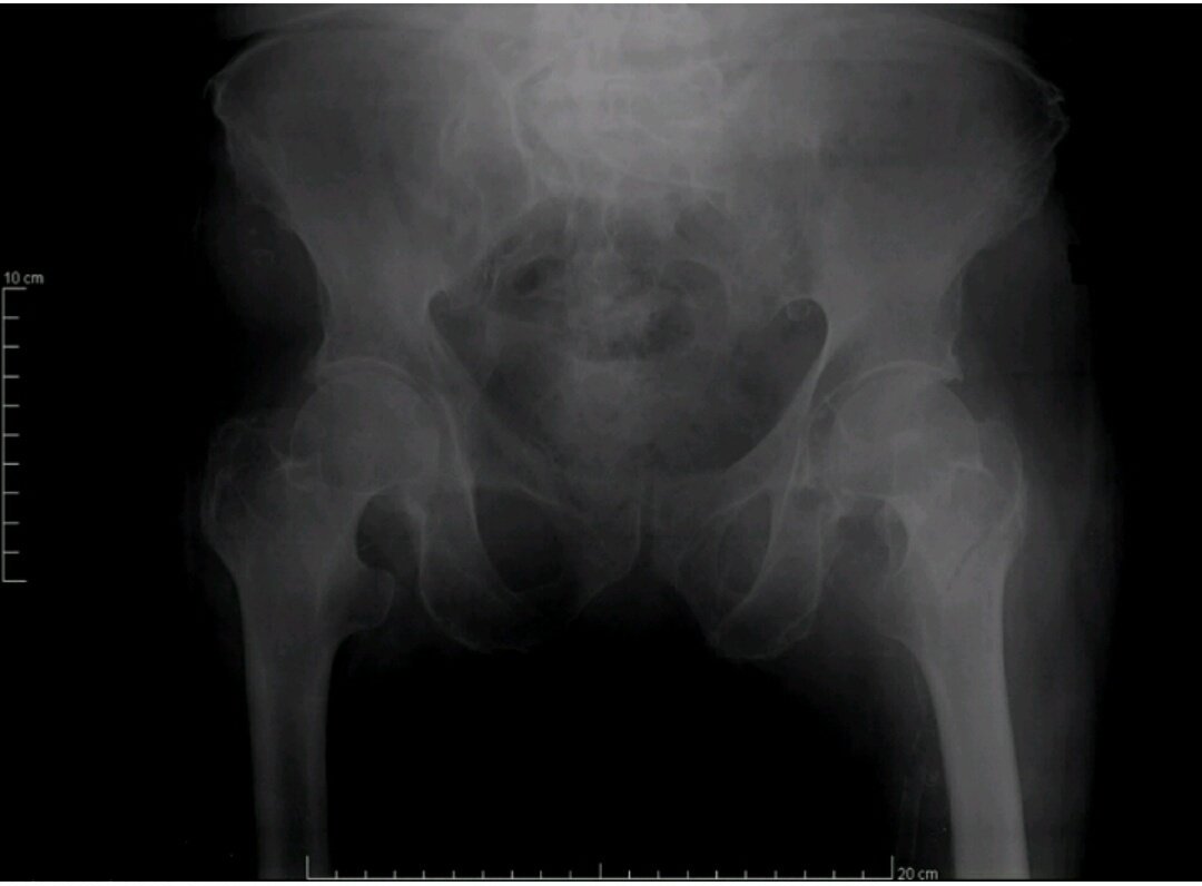 DrRabieiMR's tweet photo. Intertrochanteric fracture
89 year old fall
#FOAMed #USMLE @HeWantsTheMD 
#follow @DrRabieiMR for more #medcases https://t.co/dePJ0iT6cg