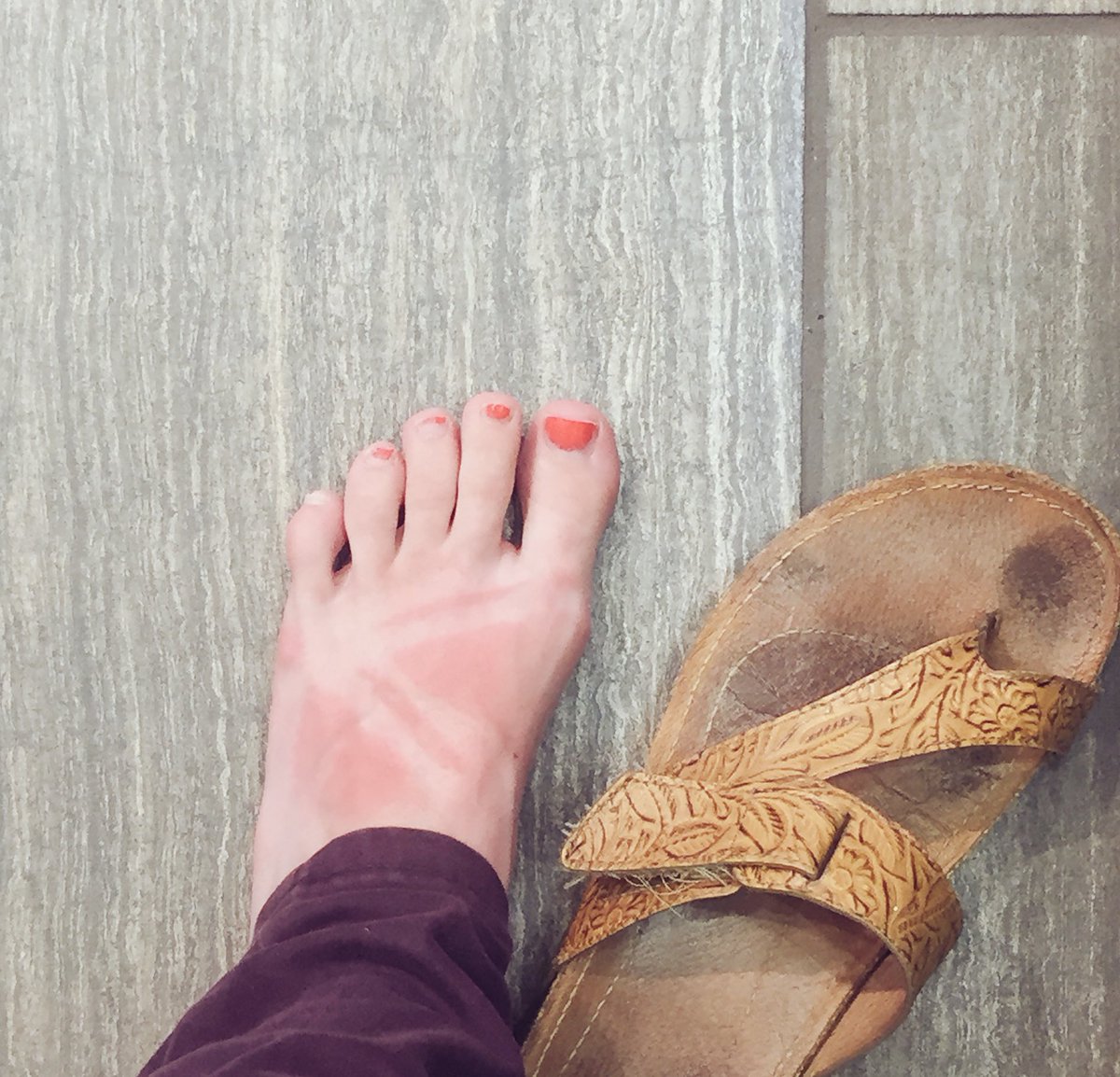 Morwegian's tweet photo. I've had this skin for a while now. You'd think I'd learn not to burn it.. #aloeveraSTAT https://t.co/HCIq4G4jTT