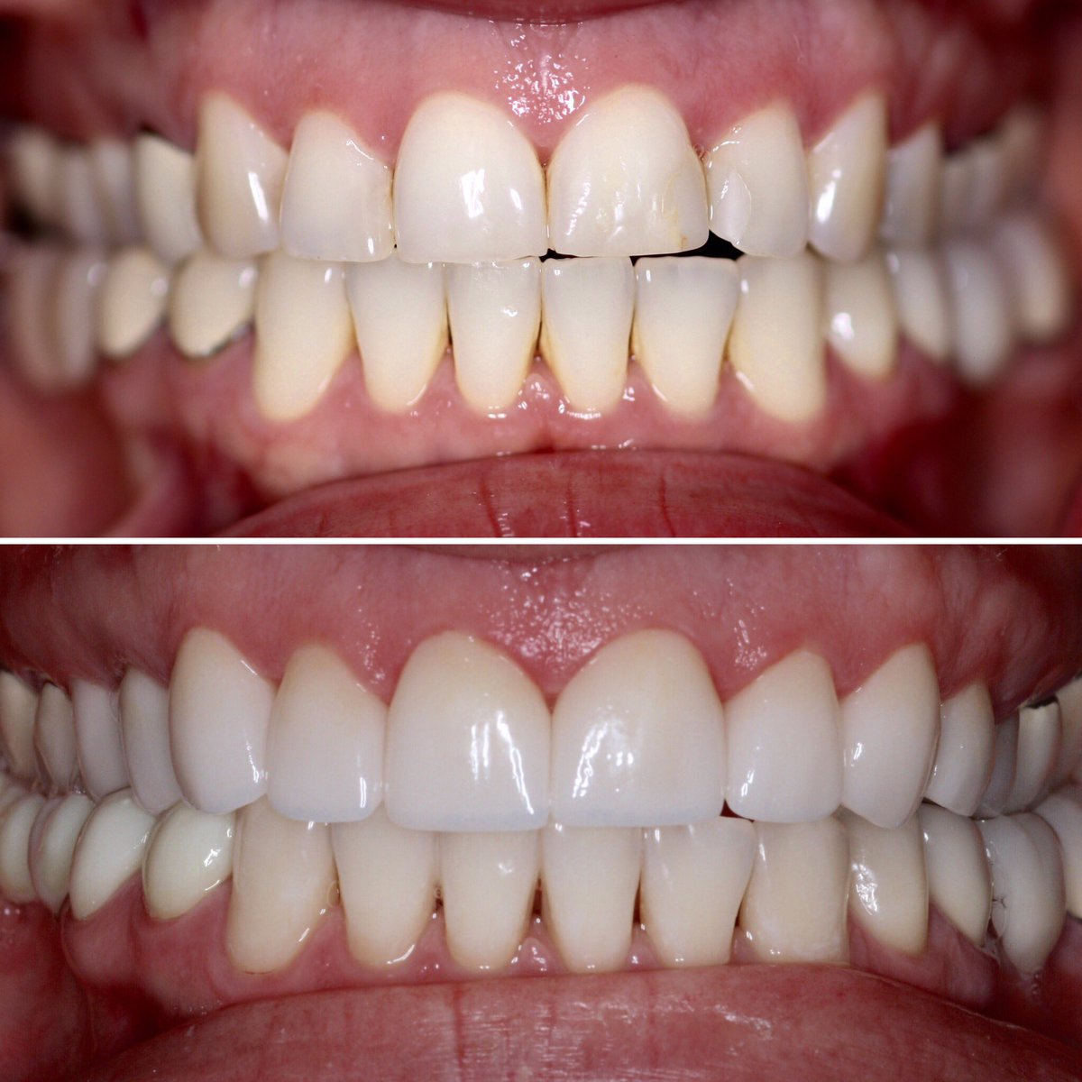drandrewjkeller's tweet photo. Upper 10 veneers, new zirconia bridge lower left, laser whitening for lowers. #bellevue #dentist #veneers https://t.co/pOieZyhXvQ