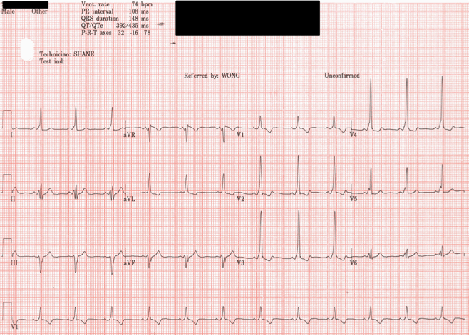ECGclass's tweet image. 28 year old man with palpitations on exercise. What&apos;s the diagnosis? #ECGClass