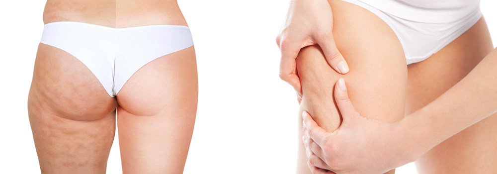 corporalcore's tweet image. Celulitis: tipos, causas y tratamientos. #CorporalCore  ow.ly/yLJQ300ItHO