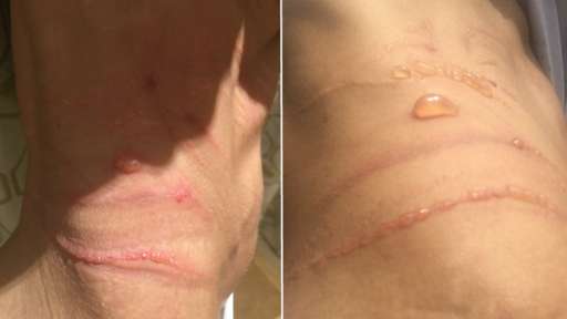 BBCEAST's tweet photo. Wedding dress 'left bride with scars' https://t.co/VQO573bSpg https://t.co/qw99o6fu0e