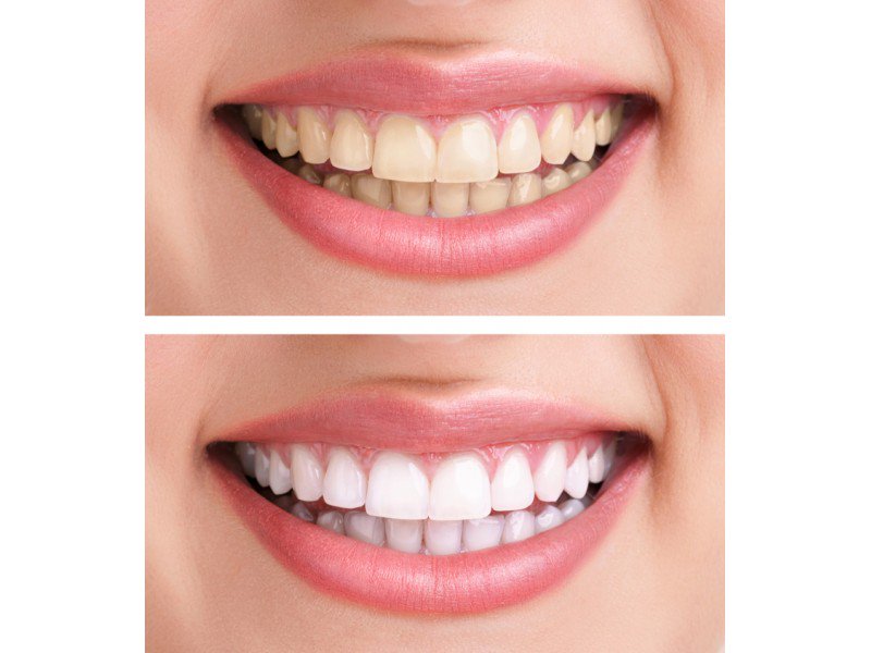 LVWhitening's tweet photo. Do you only survive Monday with coffee? 
Well face the rest of the week with a whiter smile! Book online now! $99 https://t.co/OJZy7veHKF