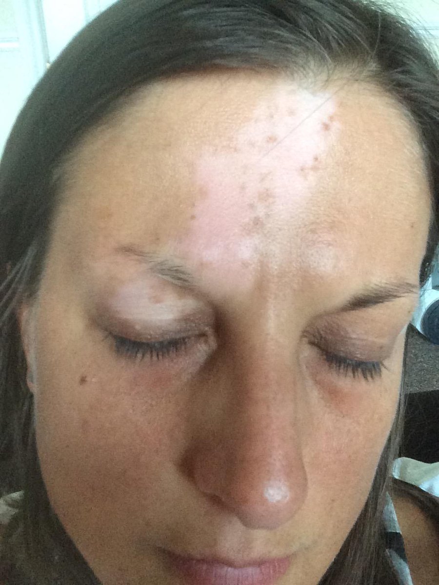 Al_McG_79's tweet photo. Some natural repigmentation since my patch appeared 10 years ago #vitiligo #repigmentation #mexico #islands #WVD2016 https://t.co/QuG8a2aUkx