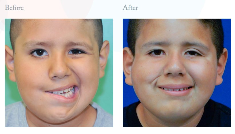 FacialParalCtr's tweet photo. Child underwent single-stage sliding temporalis myoplasty for smile reanimation &amp; simultaneous lower lip myectomy. https://t.co/IOcaLGppyP