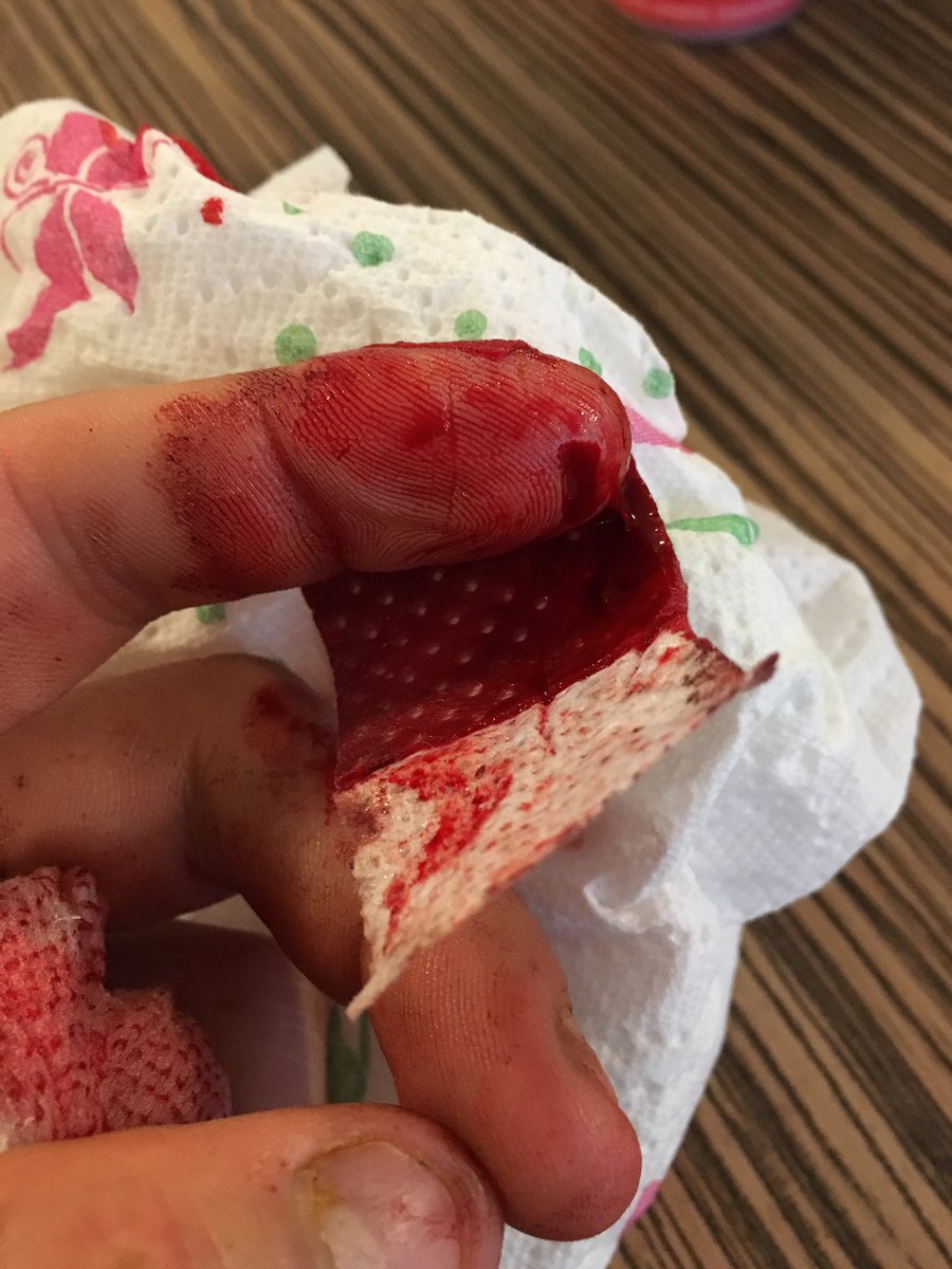 G_vdBroek's tweet photo. Gisteren een ongelukje gehad #hatemylife https://t.co/yOw9Suqvjq