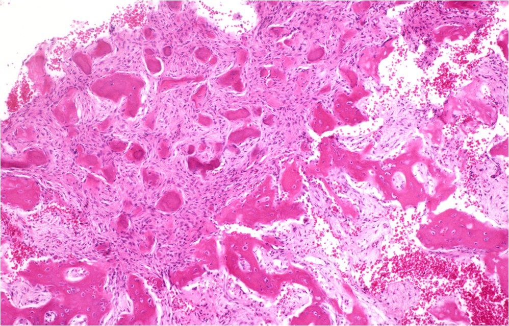 KUSAURAP's tweet image. 骨折は治癒のphaseがあるし遷延癒合になると線維化が強いとかで所見がピンキリなのでfracture callus全体像の観察が大事。 異型もあるので生検なんかで部分だけを見ると腫瘍に見える。病理医が見慣れていないのも大きな要素。