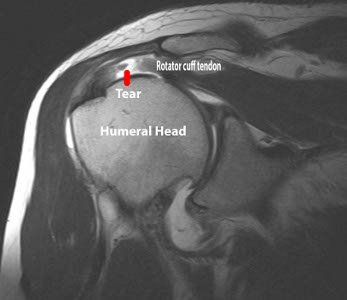 theshoulder's tweet photo. Healing Rates for Challenging Rotator Cuff Tears https://t.co/KjCGic0aK9 #rotatorcuff #healing #bone #fracture #mri https://t.co/69q9ckImmG