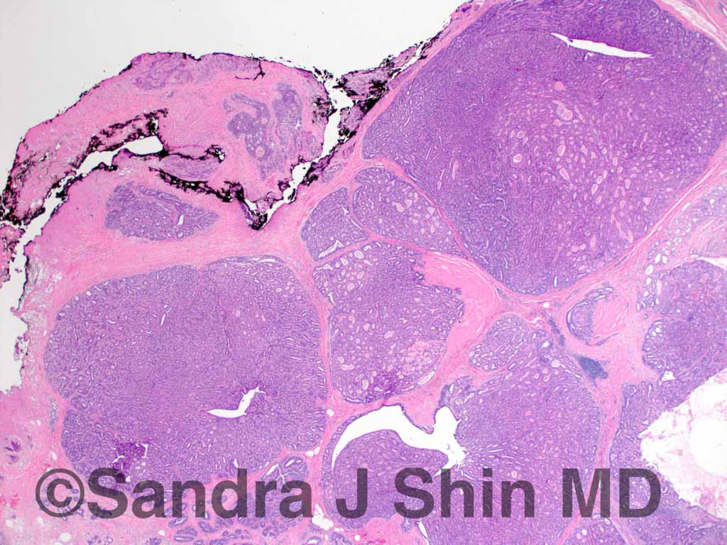 brstpathology's tweet photo. #brstpath Adenomyoepithelioma, a variant of papilloma that characteristically shows a multinodular growth pattern https://t.co/PaNIx0NnWW