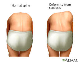 tipoist's tweet photo. SCOLIOSIS https://t.co/qZDXSV6EJM