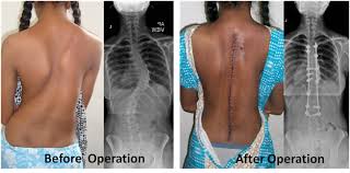 tipoist's tweet photo. SCOLIOSIS https://t.co/6Nx2GNtPpz