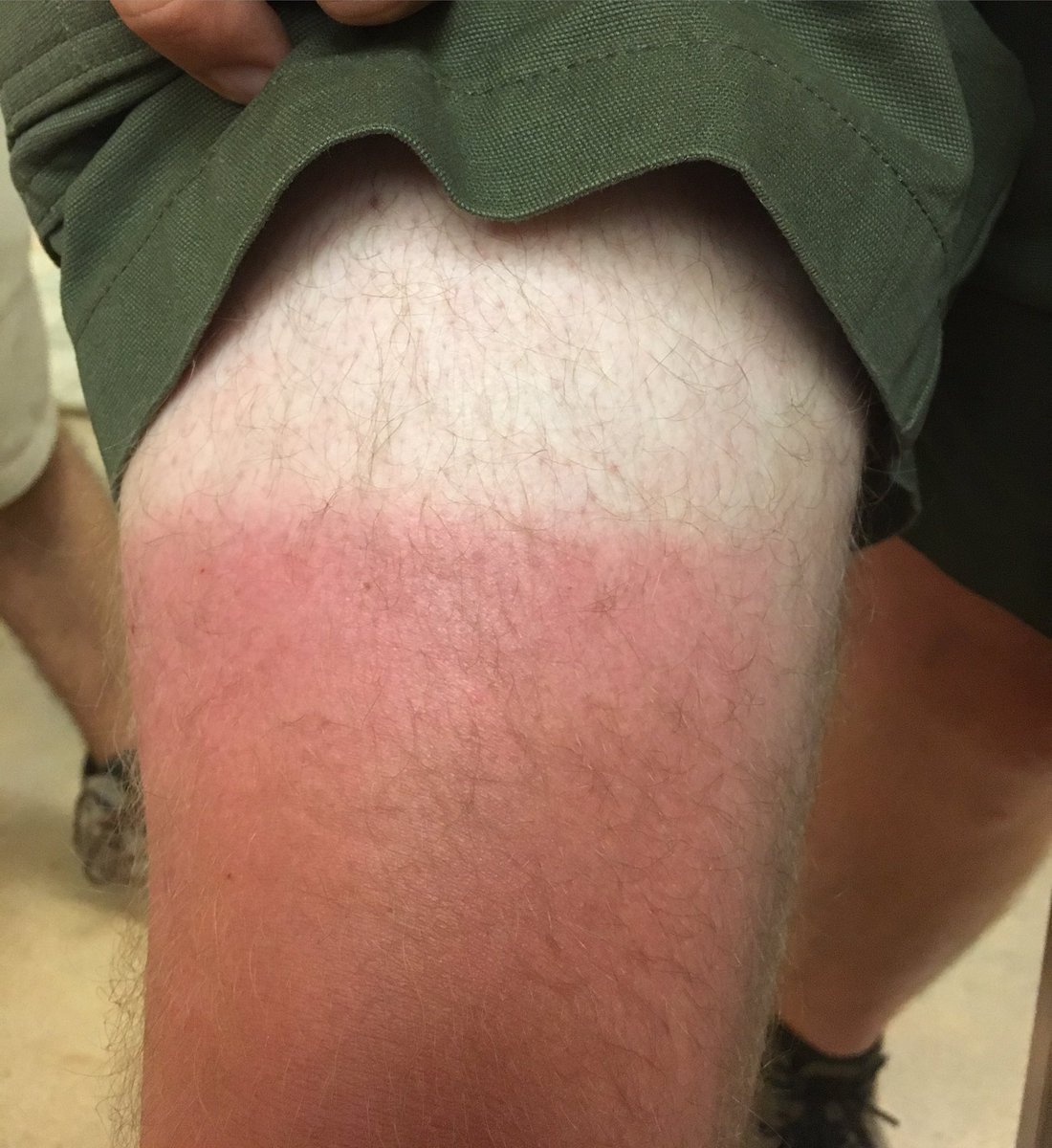 Dftrees's tweet image. Things aren't always black and white in our industry, sometimes they are red and white... #sunscreen #sunsafety