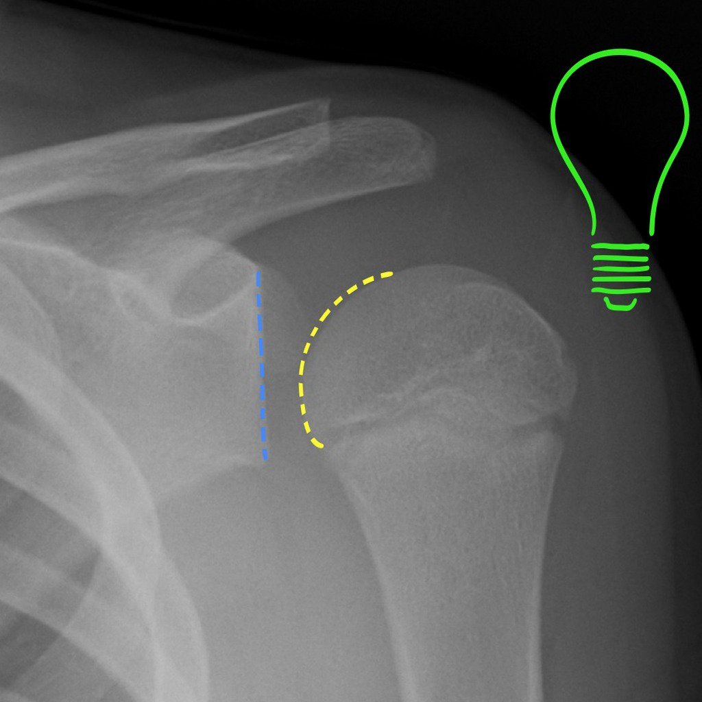 Nicoradioblogrx's tweet image. Si ves este signo radiologico que patología dirías que es? R: bit.ly/28KUJVW #foamrad #radbasic #radiologia