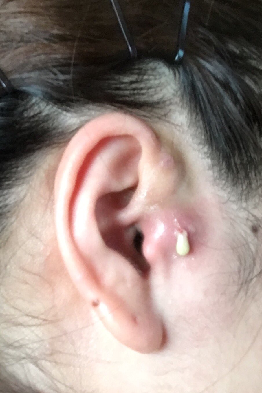 Blue Sky High Xxx 耳瘻孔の膿が破裂して グロくてすみません 炎症がひどく 膿の出口に肉芽が出来ました 血と膿 が1ヶ月止まらず 耳瘻孔手術と膿性肉芽切除で保険対象 ２泊3日の全身麻酔になります 予約待ちで手術は8月末