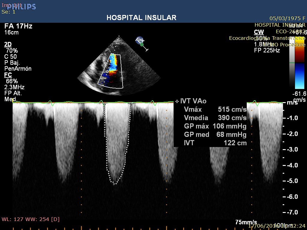 TheDocNeverDies's tweet photo. #CardioFreak Mujer de 39 años, la remiten por "soplo" Oro parece... :D @ImagCardiacaTV @cardioteca @GrupoCTO https://t.co/S3zYXAHmu7