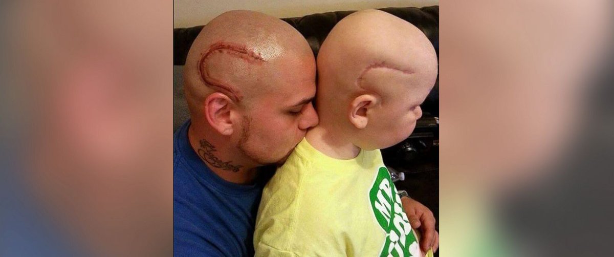 GMA's tweet photo. Dad gets tattoo to match his son's surgery scar. "They can stare at both of us.” https://t.co/WVhFaIGIZx https://t.co/4vOm8KdUTM