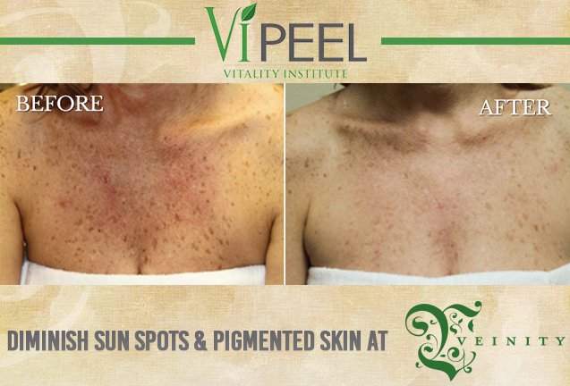 VeinitySpa's tweet photo. Hey ladies, you can now reduce the appearance of sun damage on your skin with our Vi Peel treatments at Veinity spa! https://t.co/QYwjPFIL0v