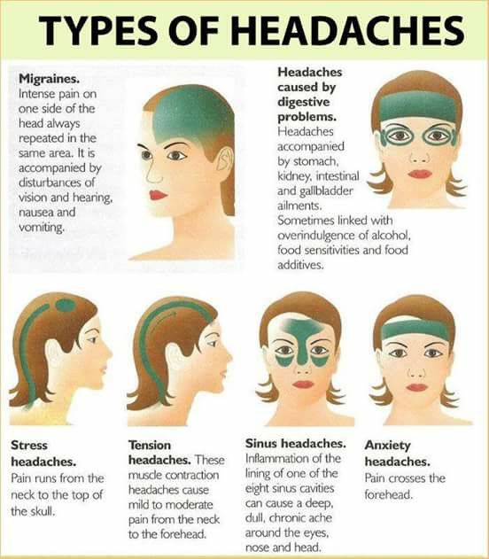 Migraine Headache Location Chart