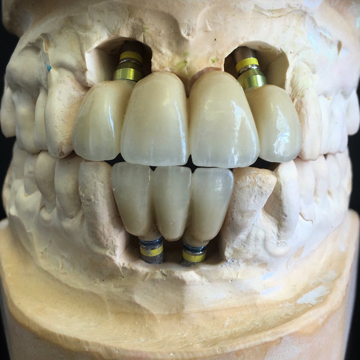 DSDdentallab's tweet photo. Nice 4 Unit and 3 unit screw retained bridges! #straumann #porcelain #bridges#teeth #dentistry #implants https://t.co/ZeXD94VQdn