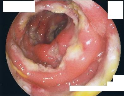 KUSAURAP's tweet image. アメーバは怪しいと思ったら吸引液や粘膜擦過を無染色で見てもわかります。これは5回あります。内視鏡的に明らかだったけど。Intestinal amoebasis. #pathology #endoscopy