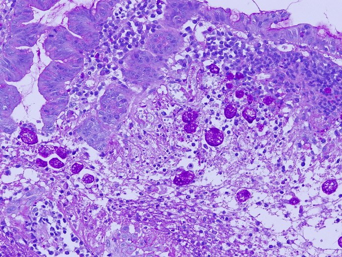 KUSAURAP's tweet image. アメーバは怪しいと思ったら吸引液や粘膜擦過を無染色で見てもわかります。これは5回あります。内視鏡的に明らかだったけど。Intestinal amoebasis. #pathology #endoscopy