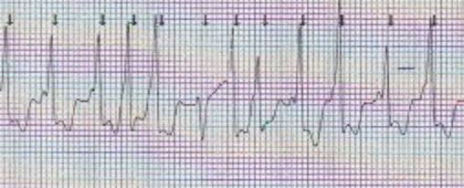 PaulPulleine's tweet image. @ECGclass