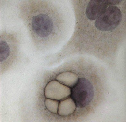 hpv alternatív terápia gyógyszerek a paraziták megszüntetésére