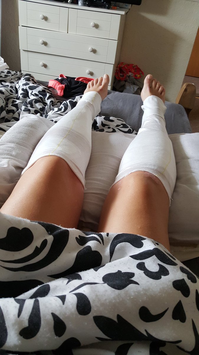 TheVapeTankDiss's tweet image. Bed bound crutches are coming out. Nothing will stop me from #VotingLeave #VoteLeave #iVoted @vote_leave #referendum