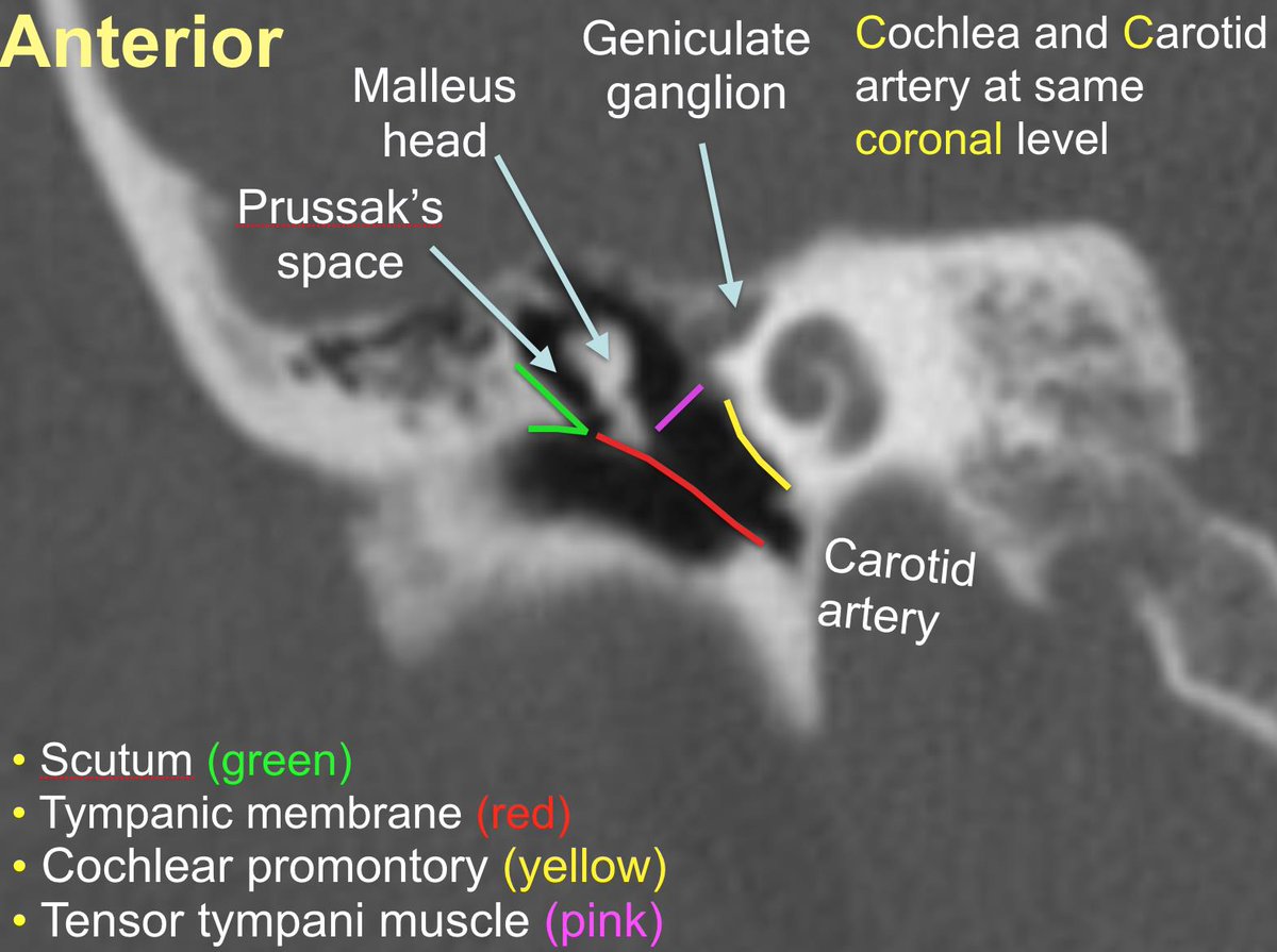 Duke Radiology on Twitter: "Primer on CT Temporal Bone Anatomy by