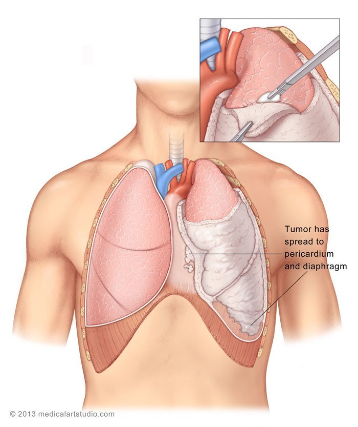 lung cancer screening and mesothelioma
