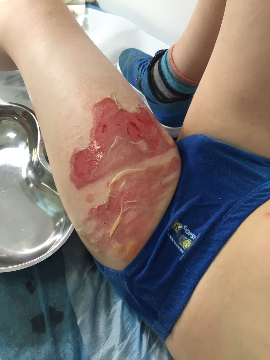 AlisonJill's tweet photo. @ThomasCookCares 
No response to my complaint re in flight scalding of my son 😡 https://t.co/MkYkV653AN