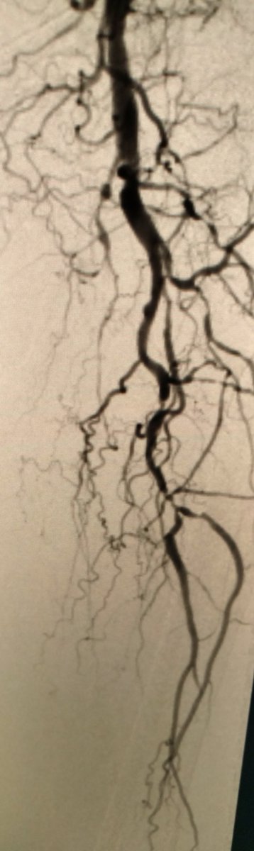 LessneVIR's tweet photo. Flush &amp; total SFA to tibial CTO revasc for #CLI inspired by @Mustapja - #tired but #inlineflow https://t.co/VsSDayrbgQ