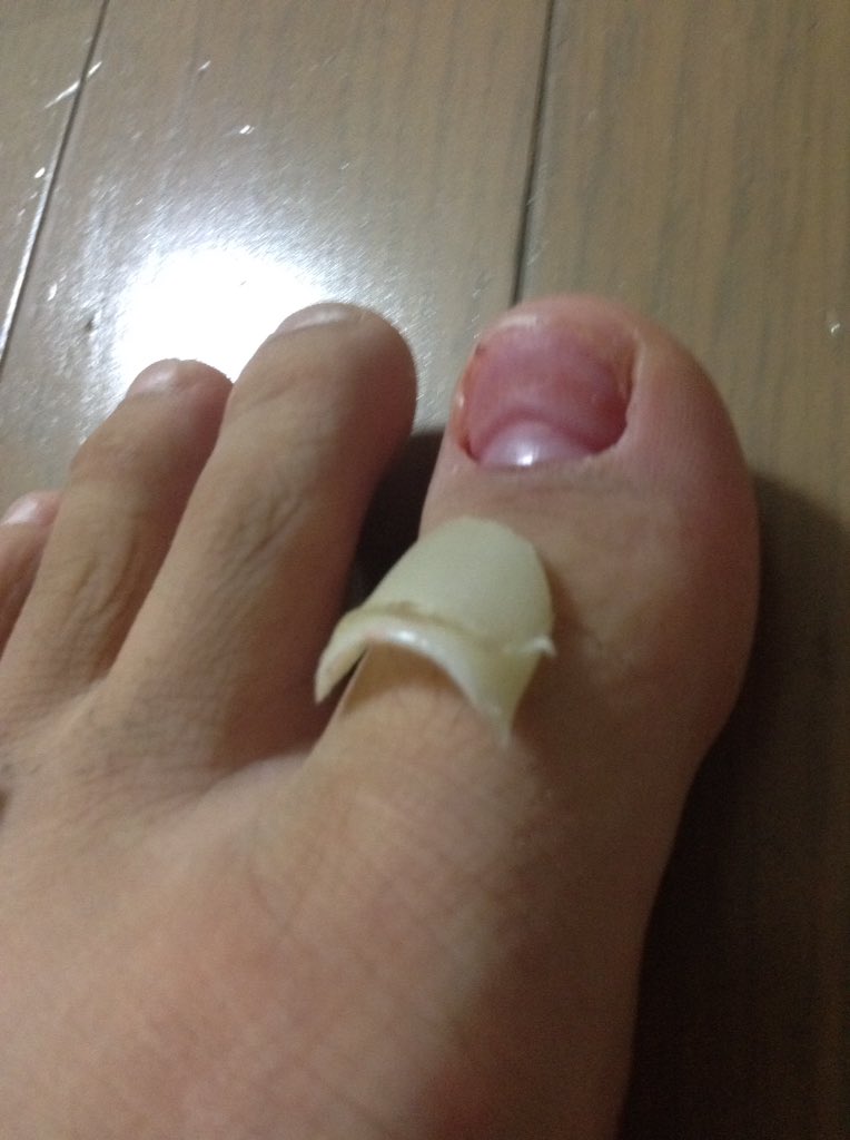 ট ইট র おうしん 爪が剥がれた笑 新しい爪がプニプニ笑笑 T Co Oscgjiou4e ট ইট র