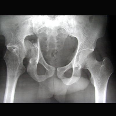 jointsmasters's tweet photo. Repairing broken hip socket (Acetabulum) requires meticulous planning and execution https://t.co/ZAJjC1C0L9