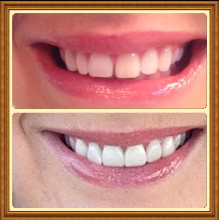 We'e #transformingsmiles at #VolnerFamilyDental! Check out these pretty veneers done by Dr. Volner! #beforeandafter