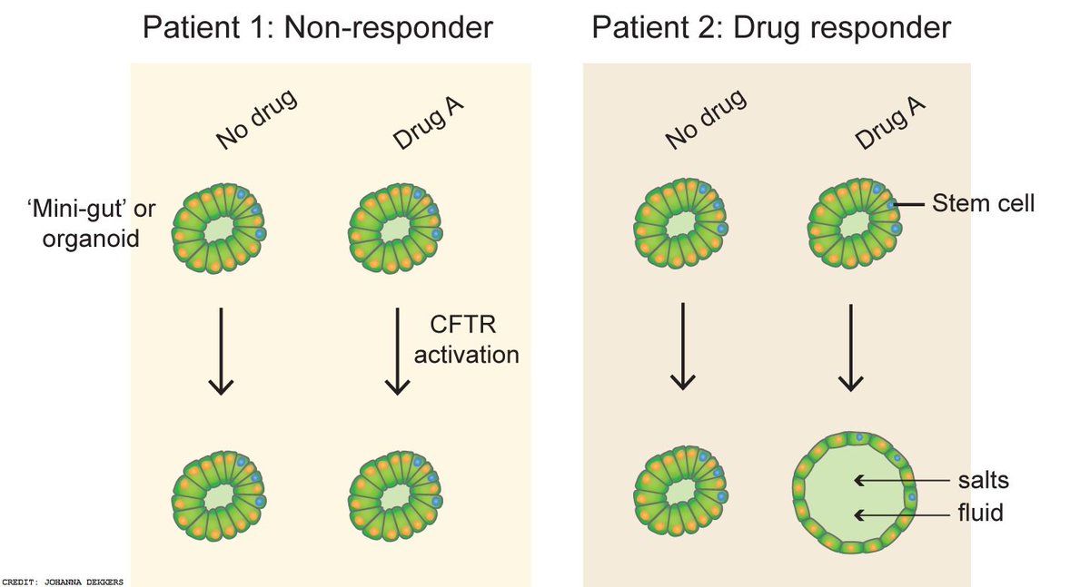 ScienceMagazine's tweet photo. "Mini-guts" can predict how cystic fibrosis patients respond to new drugs: https://t.co/HqHpkuu8FE #SciTM https://t.co/EgIsk6aw3T