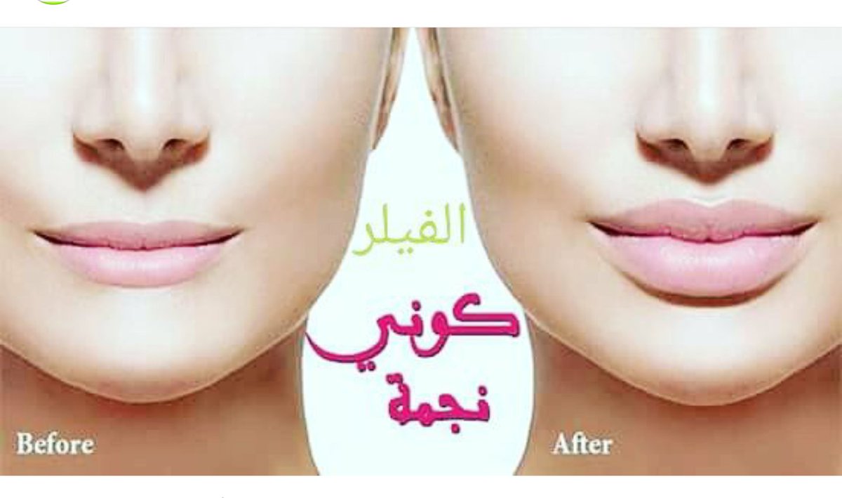 ebtsamatac's tweet photo. #فيلر تعبئه الشفايف او الخدود ✔️
تدوم حته تسع شهور الي سنه
بدون اي اثار جانبيه
تحت اشراف اخصائية
الملي 1200 بدل 1500
0536870035وتس https://t.co/uubgNLvIUA