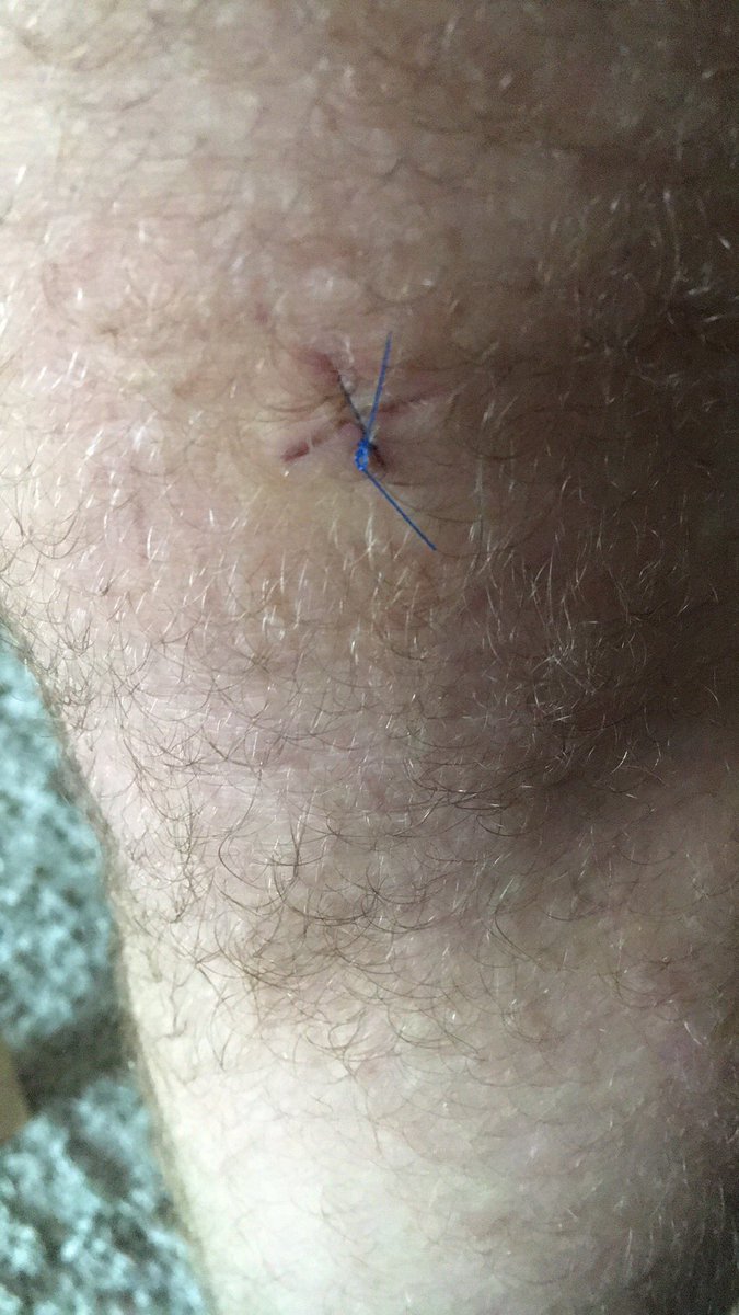 RouterST's tweet image. Need these stitches out. Desperate to start training again.