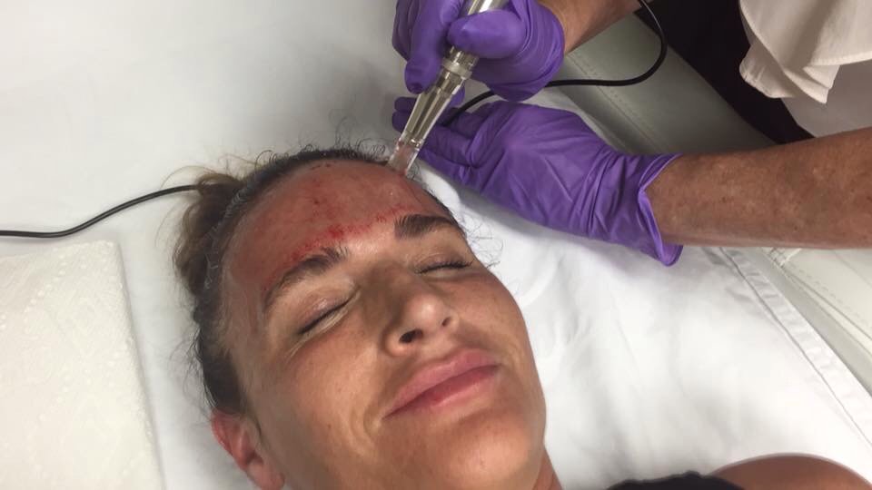 sociableaesthet's tweet photo. #MDPen #microneedling and #PRP treatment at @BalancedBodyMD1 with @kstotal. https://t.co/tLAWsK0zo1