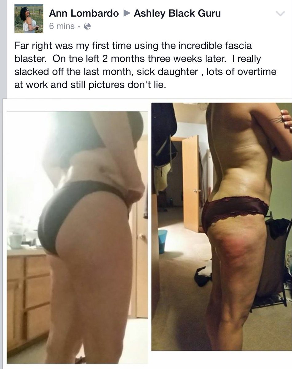realashleyblack's tweet photo. Working out but can't get rid of #cellulite? The #FasciaBlasterยฎ is the answer! Shop here: https://t.co/ynLcgrzDmF https://t.co/RsVwUux8Ji