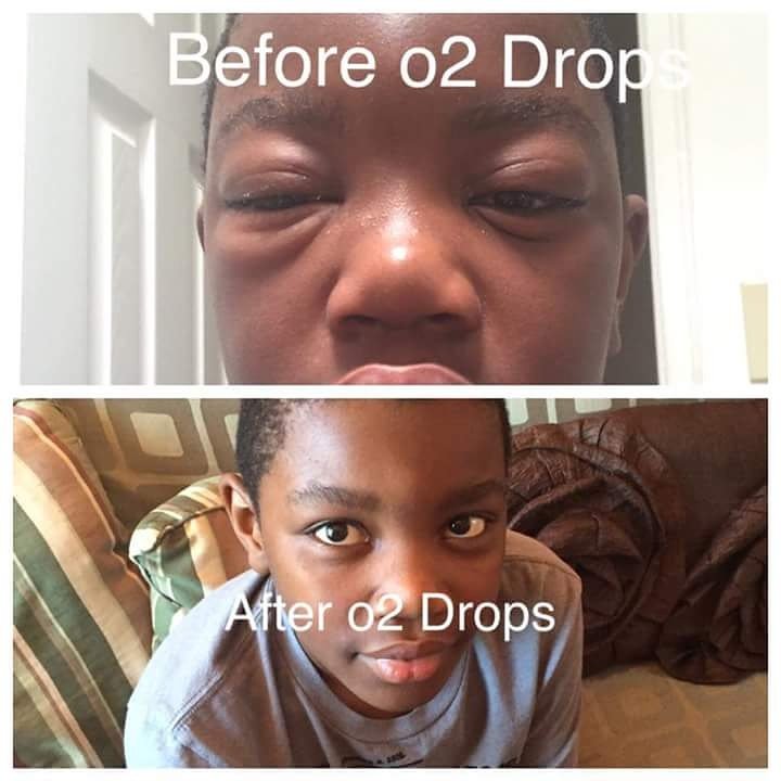 o2outrea's tweet photo. Reaction to chlorine in swimming pool.
See what happens after using the o2 drops.#o2drops #o2w #healfaster #injury https://t.co/RLbdpMO4sP