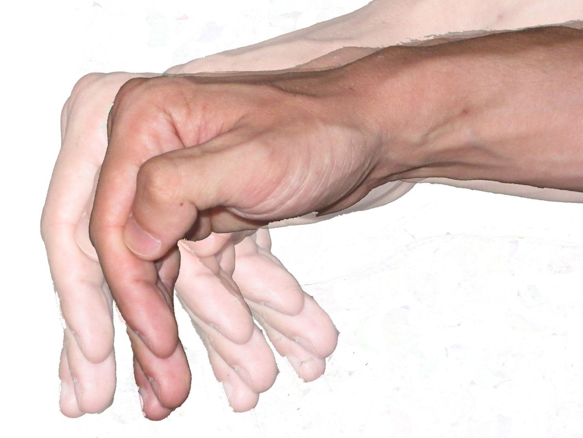 medicusmeo's tweet photo. La esperanza de vida de los enfermos de #Parkinson es parecida a la de la población general https://t.co/w7rAZg4Kwz https://t.co/BtWoqEwD8h