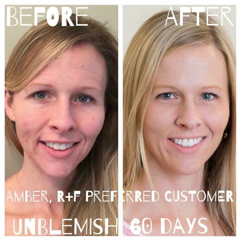 AmyBallard321's tweet photo. Wow, love Amber's 60-day results with Unblemish... https://t.co/ujysNFkUmA