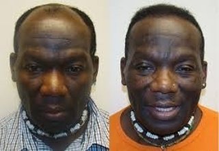 زراعة الشعر في تركيا