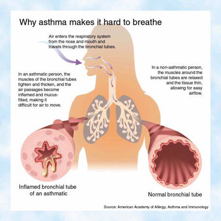 #Mold and #Asthma: Is There A Causal Link? #health bit.ly/2986pHI