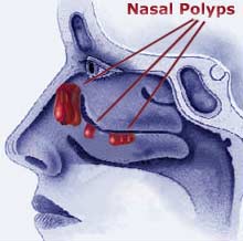 Sinus-Pro’s Nasal Polyps tablets can assist in the shrinkage &amp; elimination of nasal polyps.. bit.ly/1S1F3z2