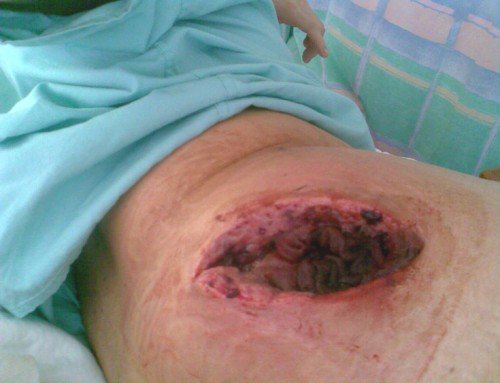 Sporkster_2012's tweet photo. .@brendon_hartwig @SueColetta1 heres the wound got infected think I should start a gofundlemepage https://t.co/ntPCLfzf3f