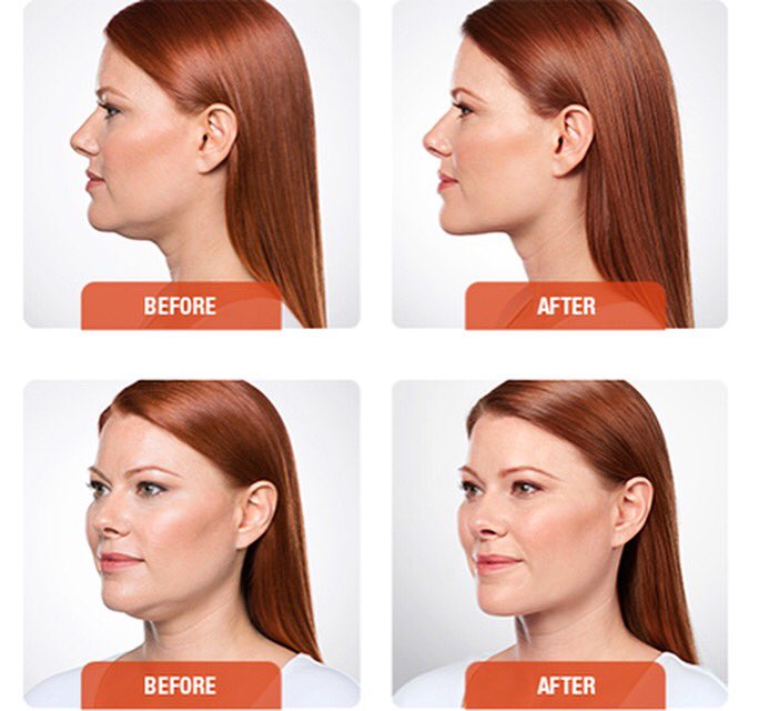 ShethDerm's tweet image. Melt away your double chin with Kybella. Call 708-323-DERM for your appointment today. #TipTuesday